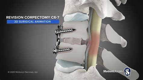 3d Surgery Animation Portrays Cervical Spine Revisions Youtube