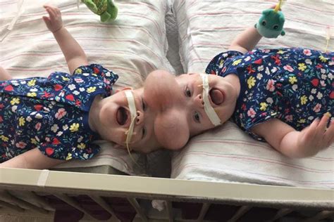 Gêmeas Siameses Ligadas Pela Cabeça Passam Por Cirurgia Para Separação