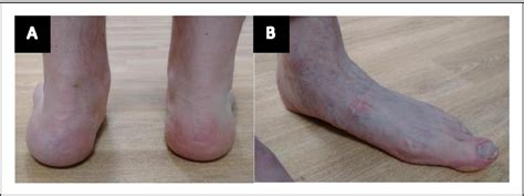 Foot Deformity In Mfs A Mild Valgus Hindfoot Deformity Of Left Foot