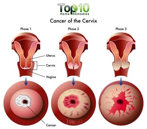 10 Warning Signs Of Cervical Cancer You Should Not Ignore ~ Health Wealth And Fitness Tips