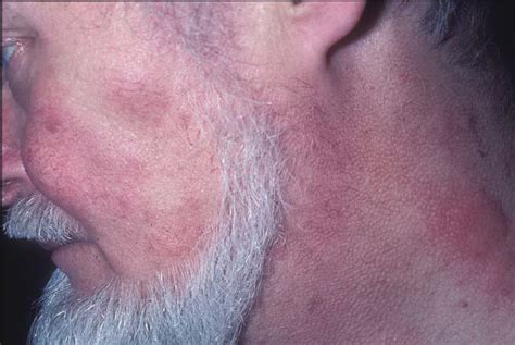 Subacute Cutaneous Lupus Erythematosus Scle الذئبة الحمامية الجلدية