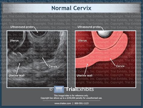 Ultrasound Of Normal Cervix Trialexhibits Inc