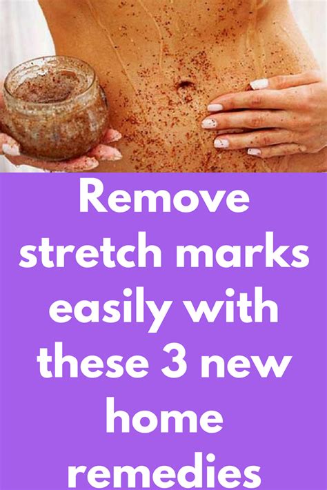 Remove Stretch Marks Easily With These 3 New Home Remedies Stretch