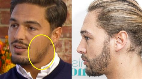Mario Falcone Beard Transplant Celebrities Hair Transplants