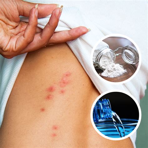 How To Get Rid Of Bed Bug Bites Bed Bug Sos