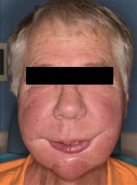Cureus Melatonin Associated Facial Swelling In An Oncology Patient
