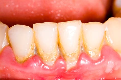 Gingivitis And Periodontitis Symptoms And Treatment Of Gum Disease Live