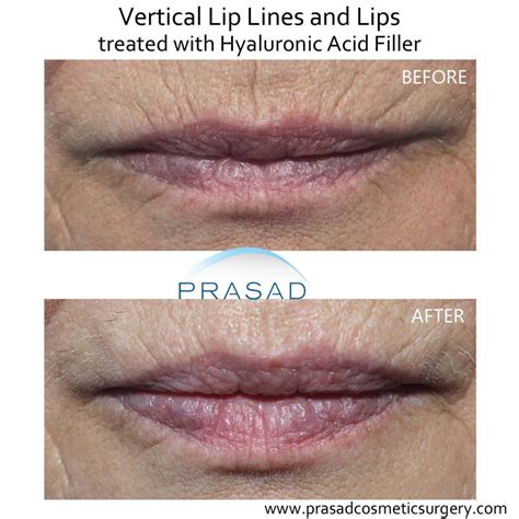 Whats The Best Treatment For Wrinkles Above Lips Dr Prasad Blog