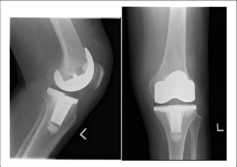 A X Ray Radiograph Of Left Knee Soft Tissue Swelling In Suprapatellar