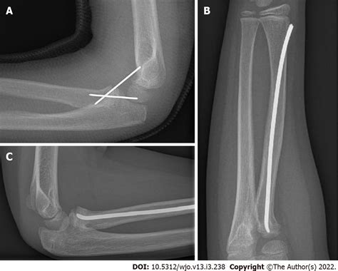 Diagnosis Treatment And Complications Of Radial Head And Neck Fractures In The Pediatric Patient