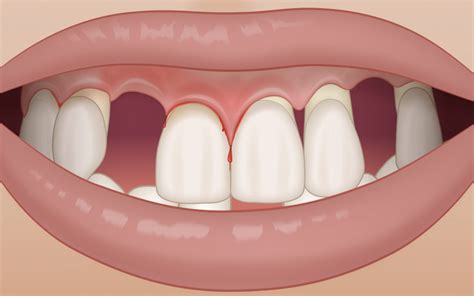 Consequences Of Periodontitis Read All Info At Periodontal