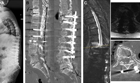 Proximal Junctional Kyphosis And Failure Strategies For Prevention