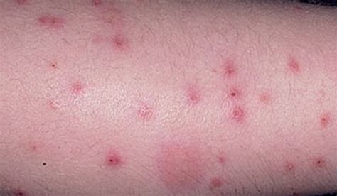 Flea Bites On Humans Symptoms Treatment Pictures Youmemindbody