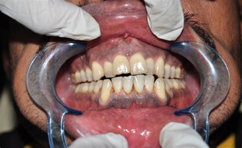 Preoperative View Showing Diffuse Melanin Pigmentation Download