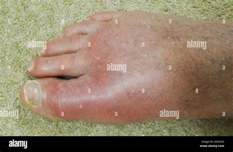 Can Gout Cause Ankle Swelling