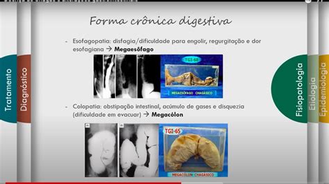 Doenca De Chagas No Intestino