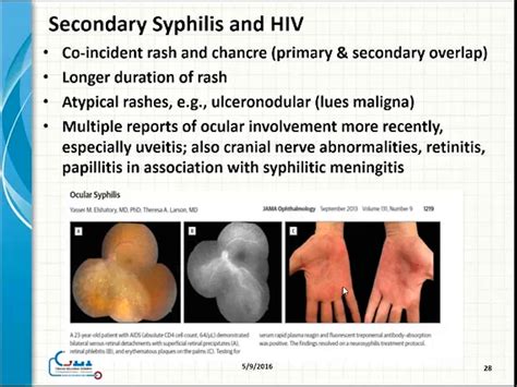 Congenital Syphilis Diagram