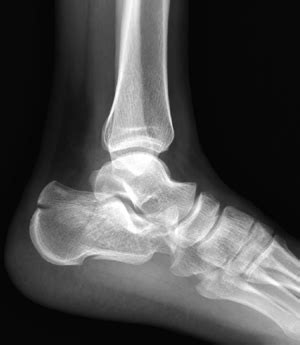 Top 134 Fractured Heel Recovery Time Jtcvietnam Edu Vn