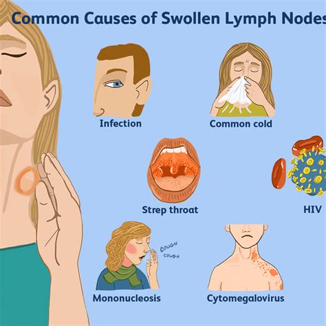 A swollen lymph node should resolve without treatment. Help Drain Swollen Lymph Nodes - Best Drain Photos ...