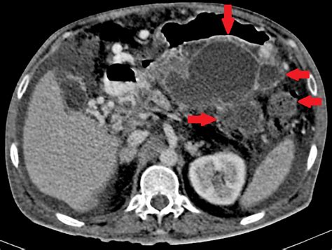 Cureus Mediastinal Eventration Of A Pseudocyst Of Pancreas Presenting