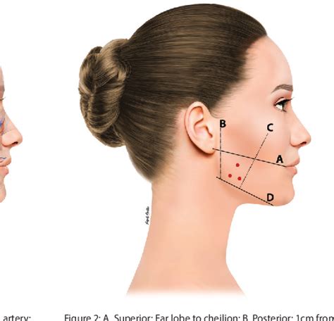 Figure 1 From Management Of Masseter Hypertrophy And Bruxism With