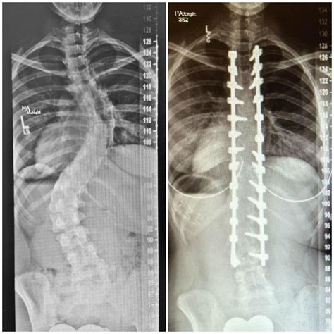 Scoliosis Surgery X Ray