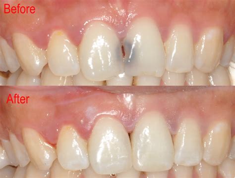 Front Tooth Cavity Before And After
