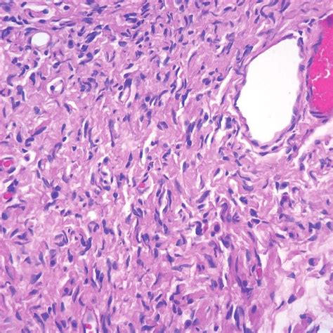 Histopathology Of Neurofibroma Showing Schwann Cells With Wavy Nucleus