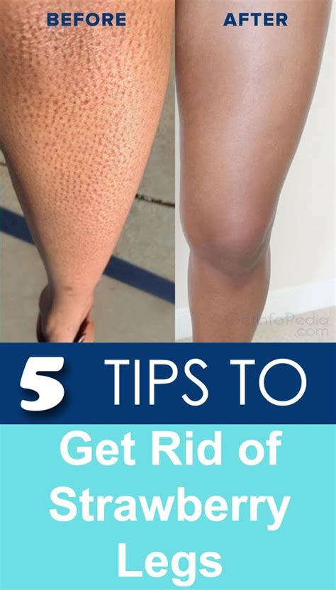 Tips To Get Rid Of Strawberry Legs Geeks Fashion