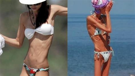 Anorektyczki w bikini Czy naprawdę chciałabyś tak wyglądać na plaży