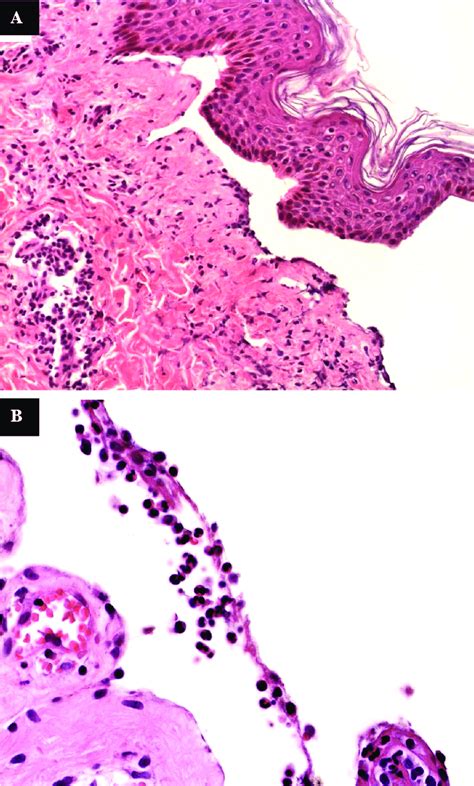 Mucous Membrane Pemphigoid Histology