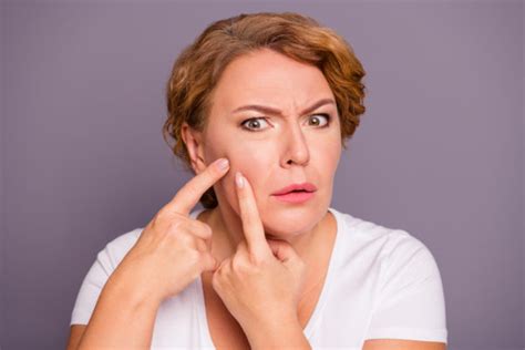 Menopausal Acne How It Happens And What You Can Do About It