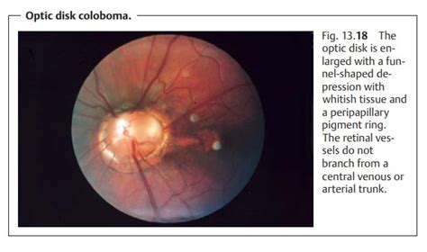 Optic Disk Coloboma Morning Glory Disk