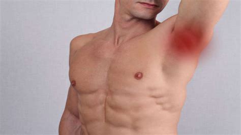 Armpit Lumps Causes Symptoms And Treatment