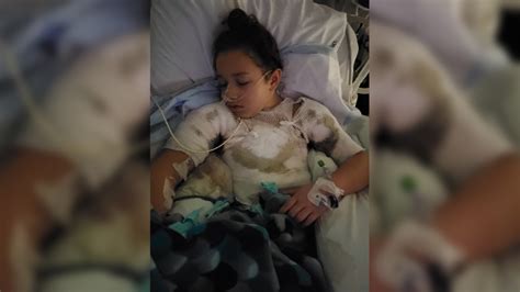8 Year Old Girl Severely Burned After Candle Catches Shirt On Fire