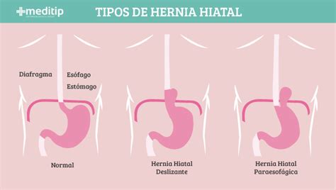Alteraciones Digestivas Hernia De Hiato