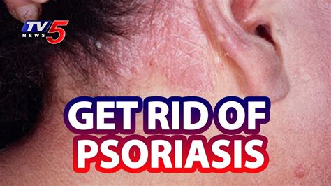 How To Overcome Psoriasis Treatment Symptoms Diet And Causes Tv5