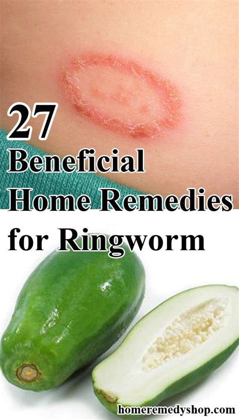 23 Beneficial Home Remedies For Ringworm Homeremedies Home