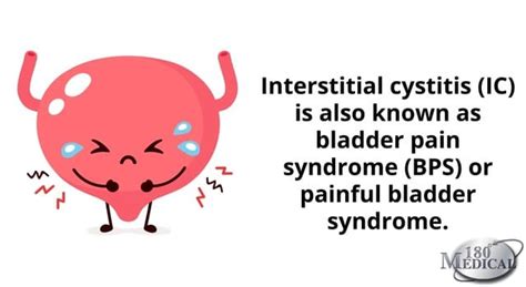 Interstitial Cystitis Faqs For Ic Awareness Month 180 Medical