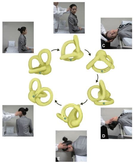 Modified Epleys Maneuver For The Treatment Of Right Pc Bppv After The
