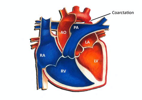 Coarctation Of The Aorta Surgical Repair Pediatric Heart Specialists