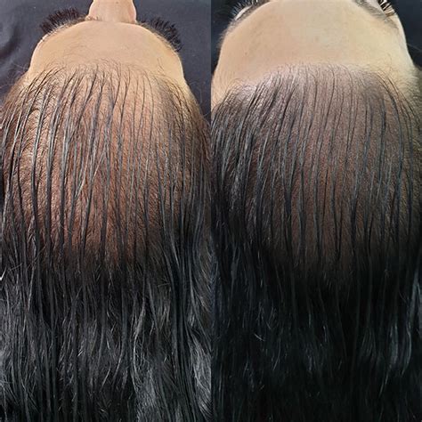 Our Clients ️ It Before And After Scalp Micropigmentation For Women