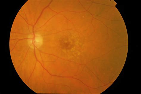 Macular Degeneration And Things That Go Bump In The Eye Life Apps