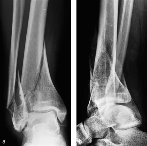 Tibia And Fibula Distal Intraarticular Simple Fracture Of The Distal