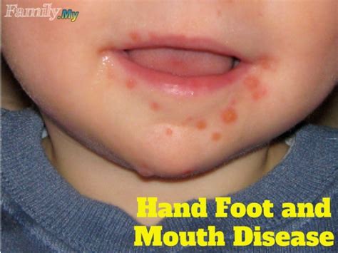 Hand Foot And Mouth Disease Healthcare Malaysia