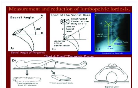 A In The Sagittal Plane Measurement Of The Angle Of The Sacral Base