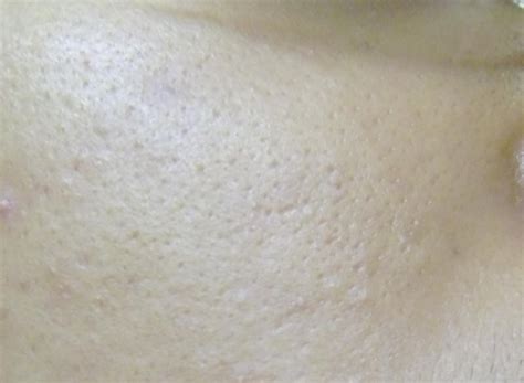 Tiny Little Whiteheads Like Bumps Which Have Redinflamed Bases Cause