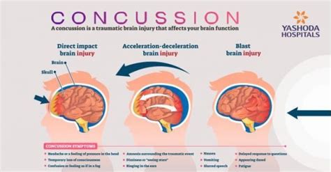 Concussion Symptoms Causes Diagnosis And Treatments