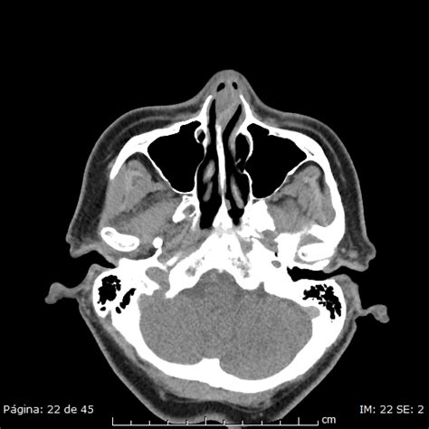 Nasal Septal Hematoma Image