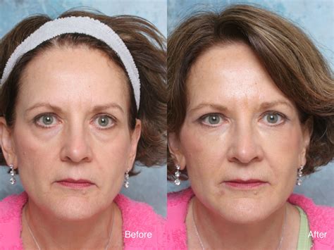 How To Remove Eye Bags Naturally And Surgically Bellatory
